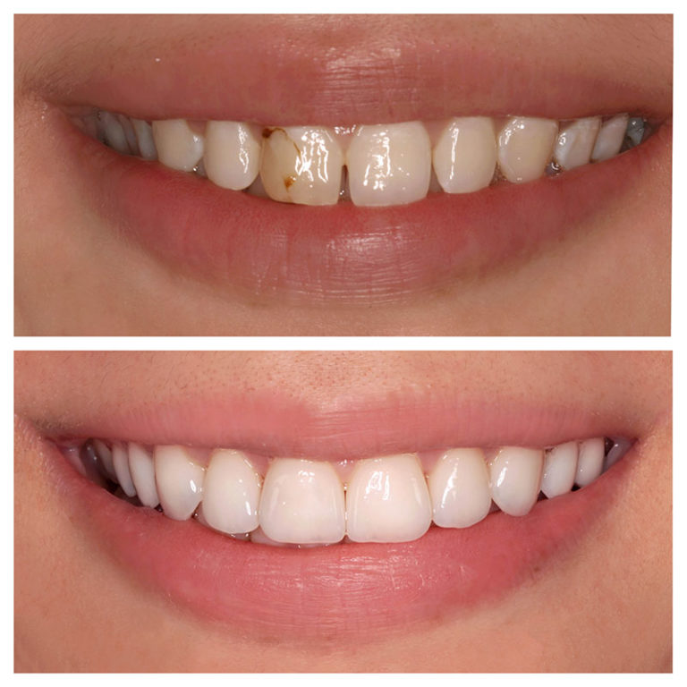 porcelain veneers before and after