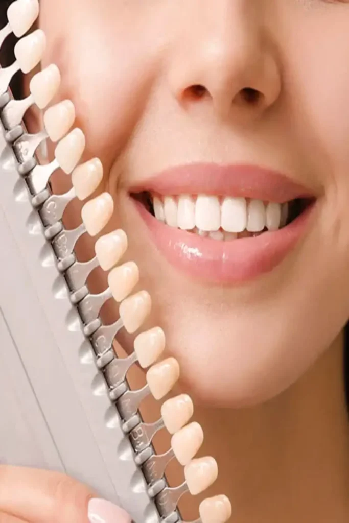 colour-of-porcelain-veneers_1000x1500