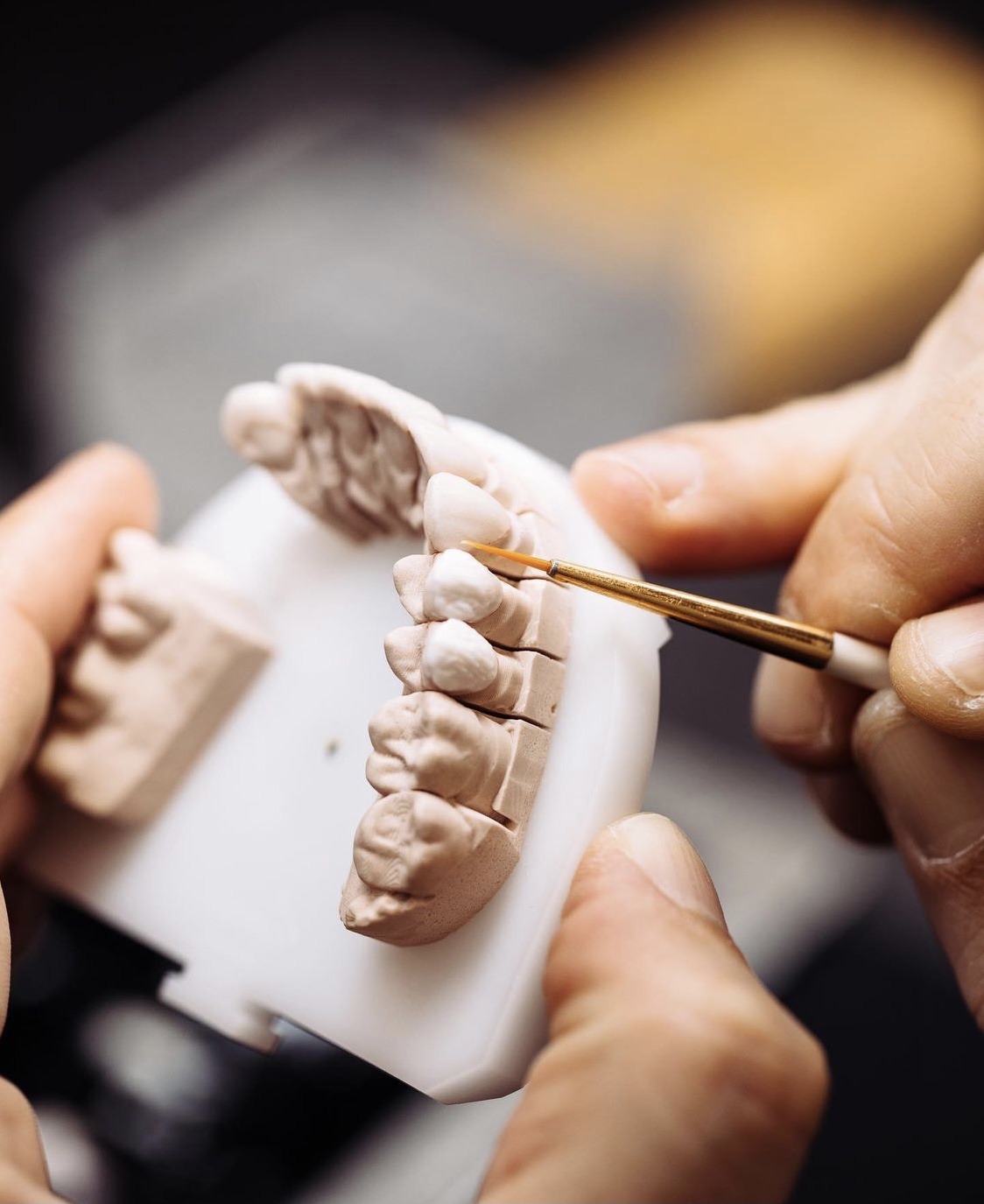 porcelain veneers cost in Australia Porcelain Veneers Sydney Cost