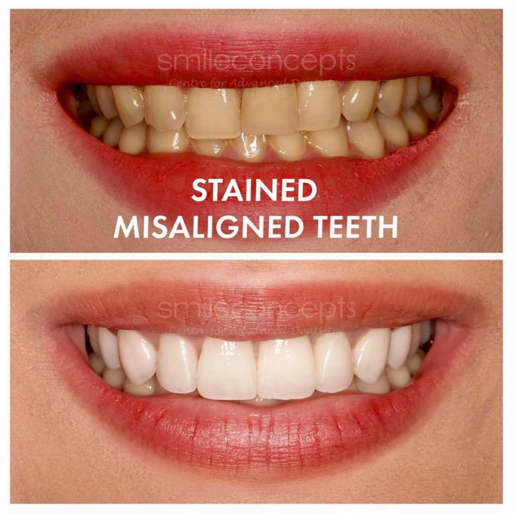 stained-teeth-1