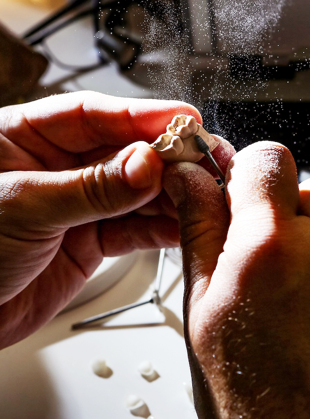 Composite vs Resin Bonding Veneers