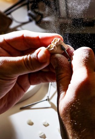 Composite vs Resin Bonding Veneers