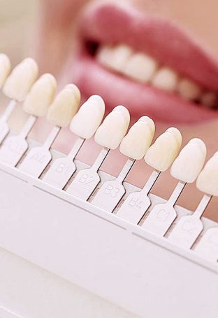 colours-veneers-yellow