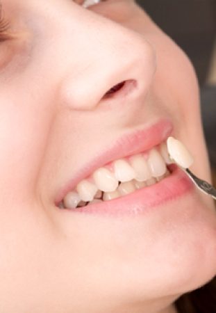 crowns for teeth
