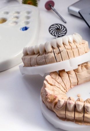 composite vs porcelain veneers