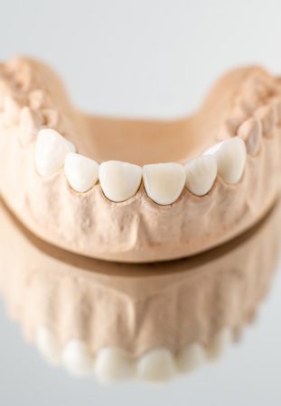 Sydney veneers cost